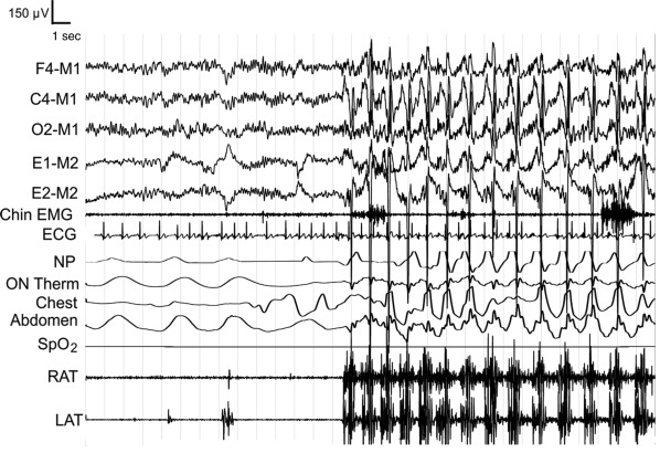 PMD-EEG